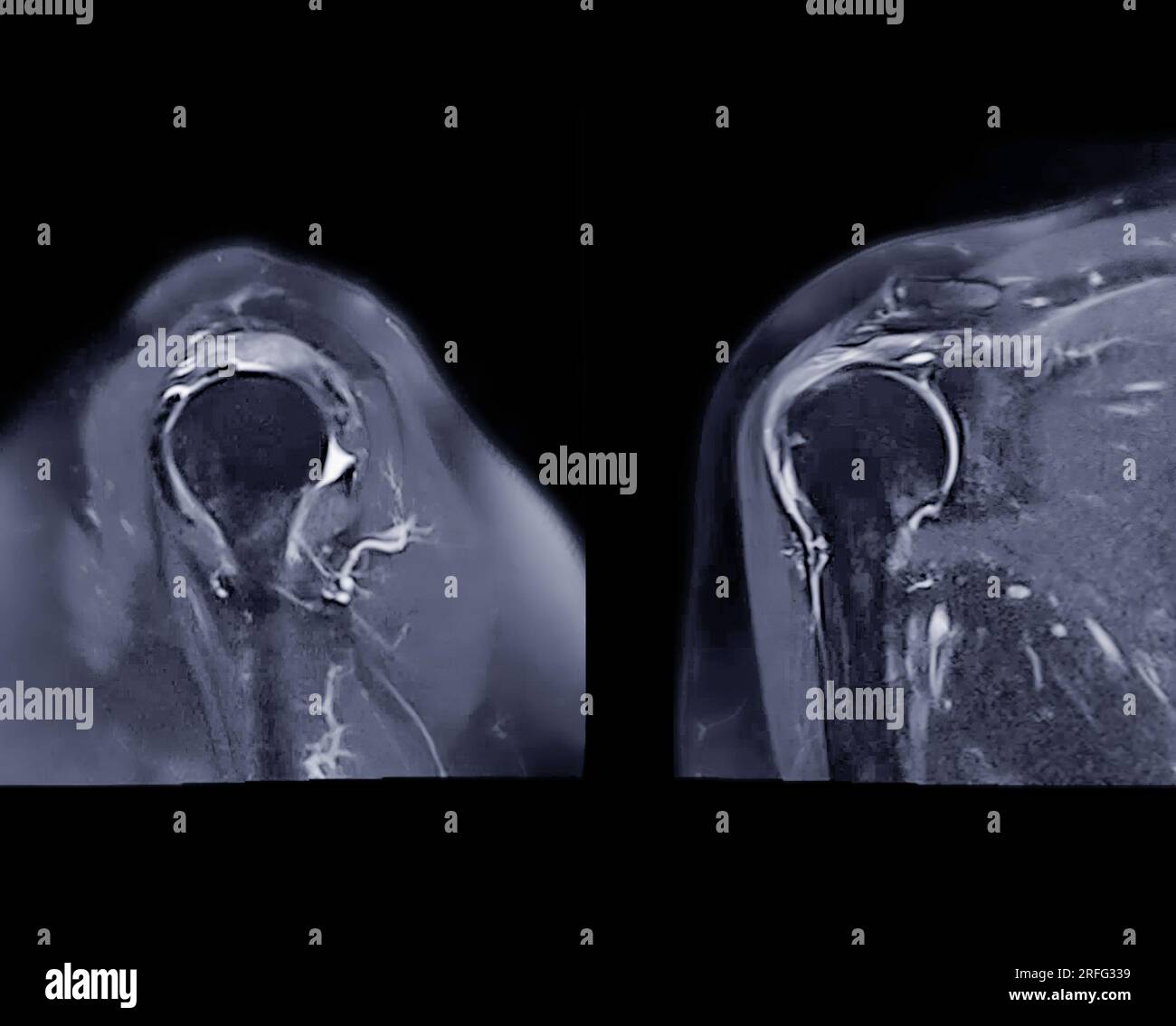 Resonance Imaging or MRI of Shoulder Joint Sagittal and