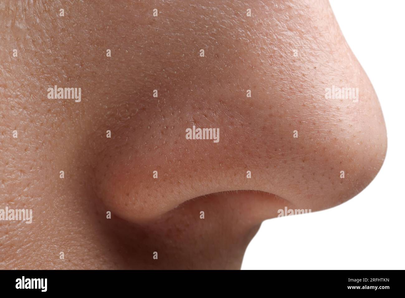 Young woman with acne problem on white background, closeup view of nose Stock Photo