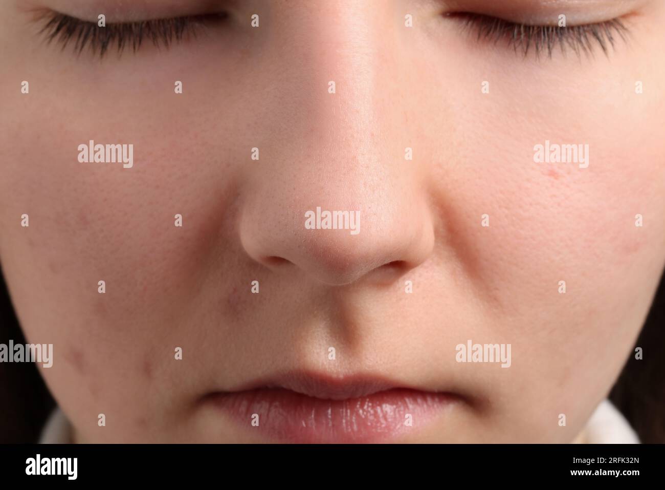 Young woman with acne problem, closeup view Stock Photo