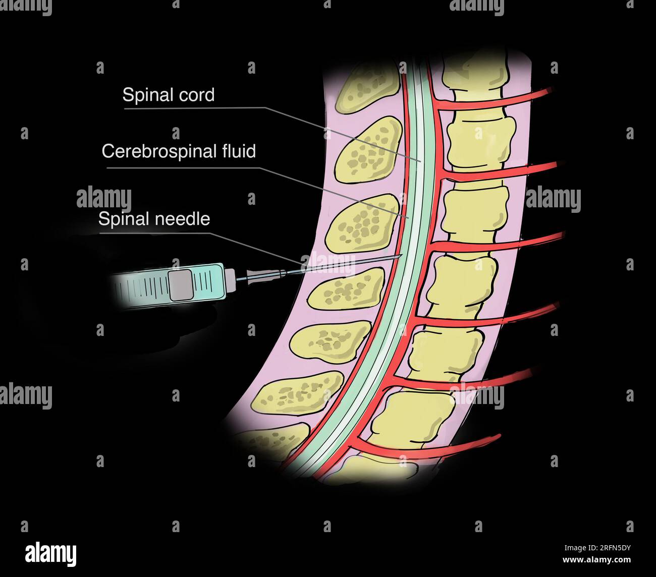 A lumbar puncture (spinal tap) is a test used to diagnose certain A lumbar puncture (spinal tap) is a test used to diagnose certain