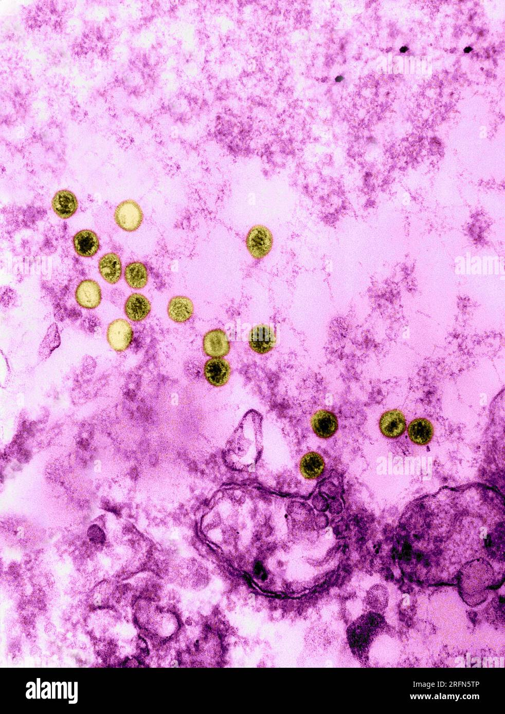 Epstein-Barr Virus, TEM Stock Photo - Alamy