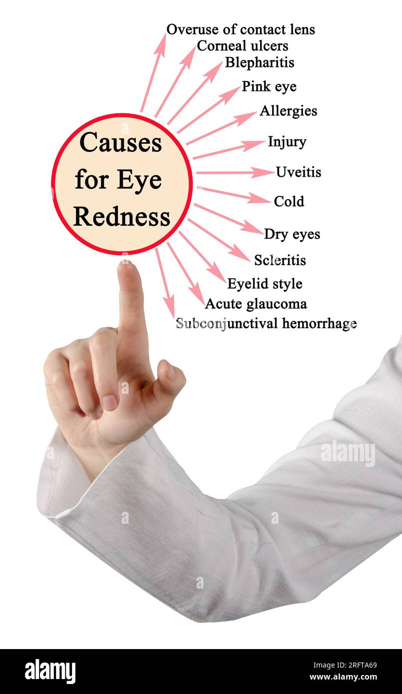 13 Causes for Eye Redness Stock Photo
