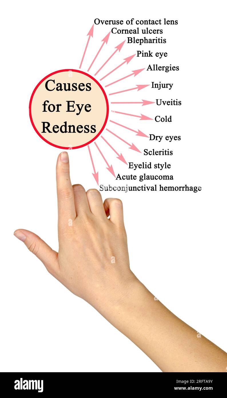 13 Causes for Eye Redness Stock Photo Alamy