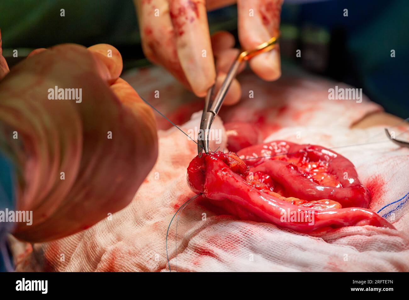 Surgical operation, closeup on operating field and hands of surgeons. Stock Photo