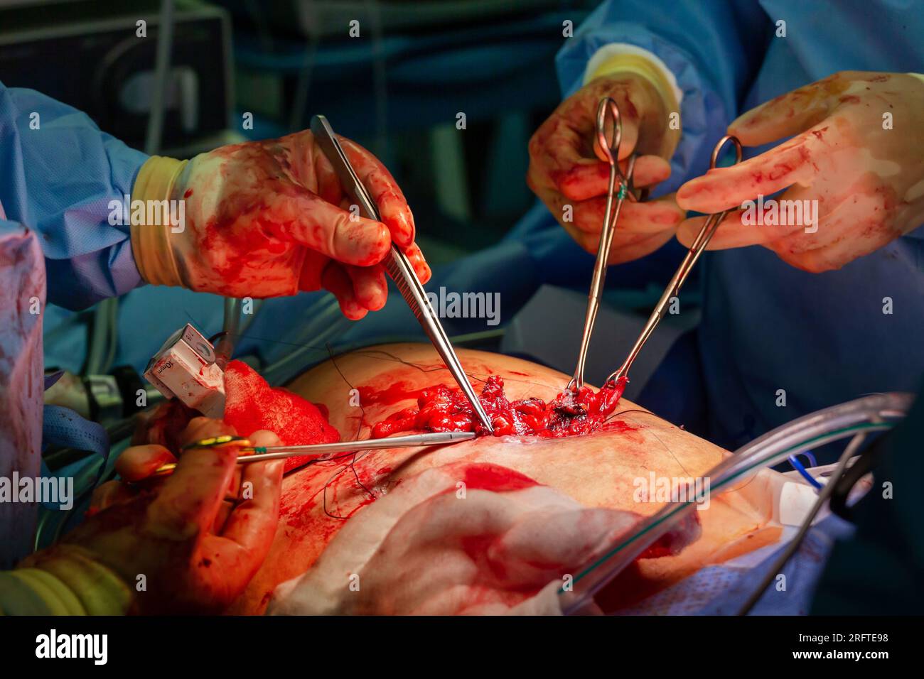 Surgical operation, closeup on operating field and hands of surgeons. Stock Photo