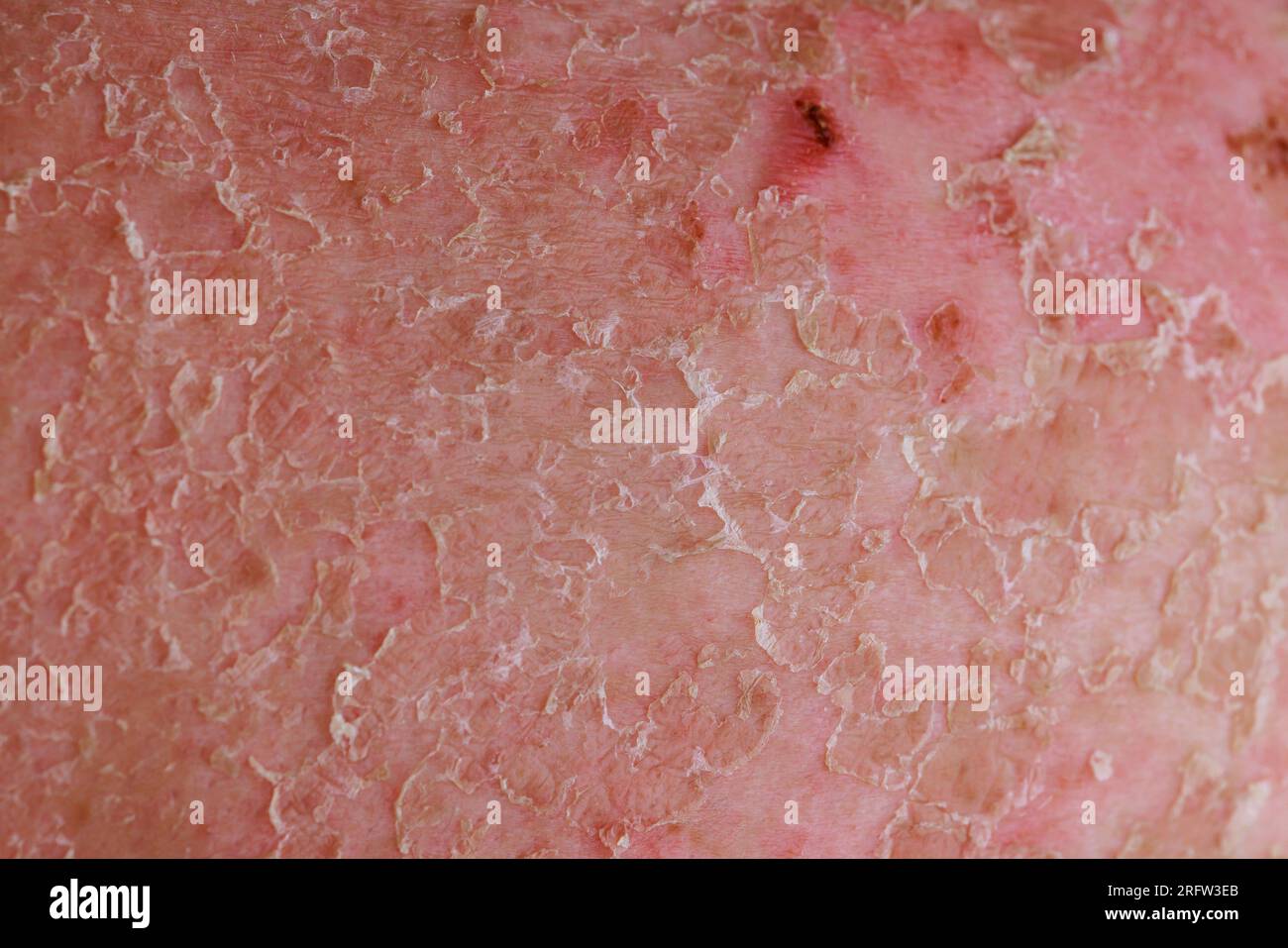 Psoriatic eczema is skin condition that falls under realm of