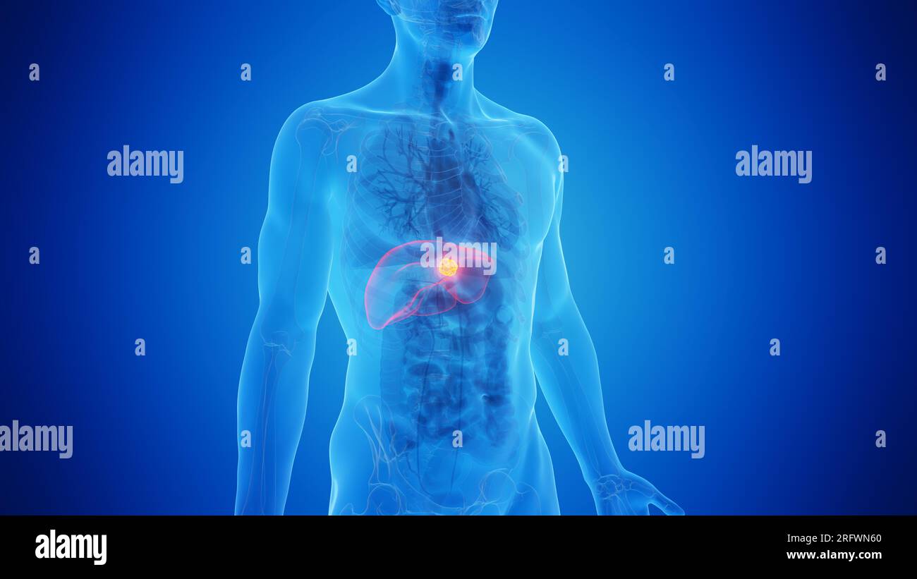 Liver cancer, illustration Stock Photo - Alamy