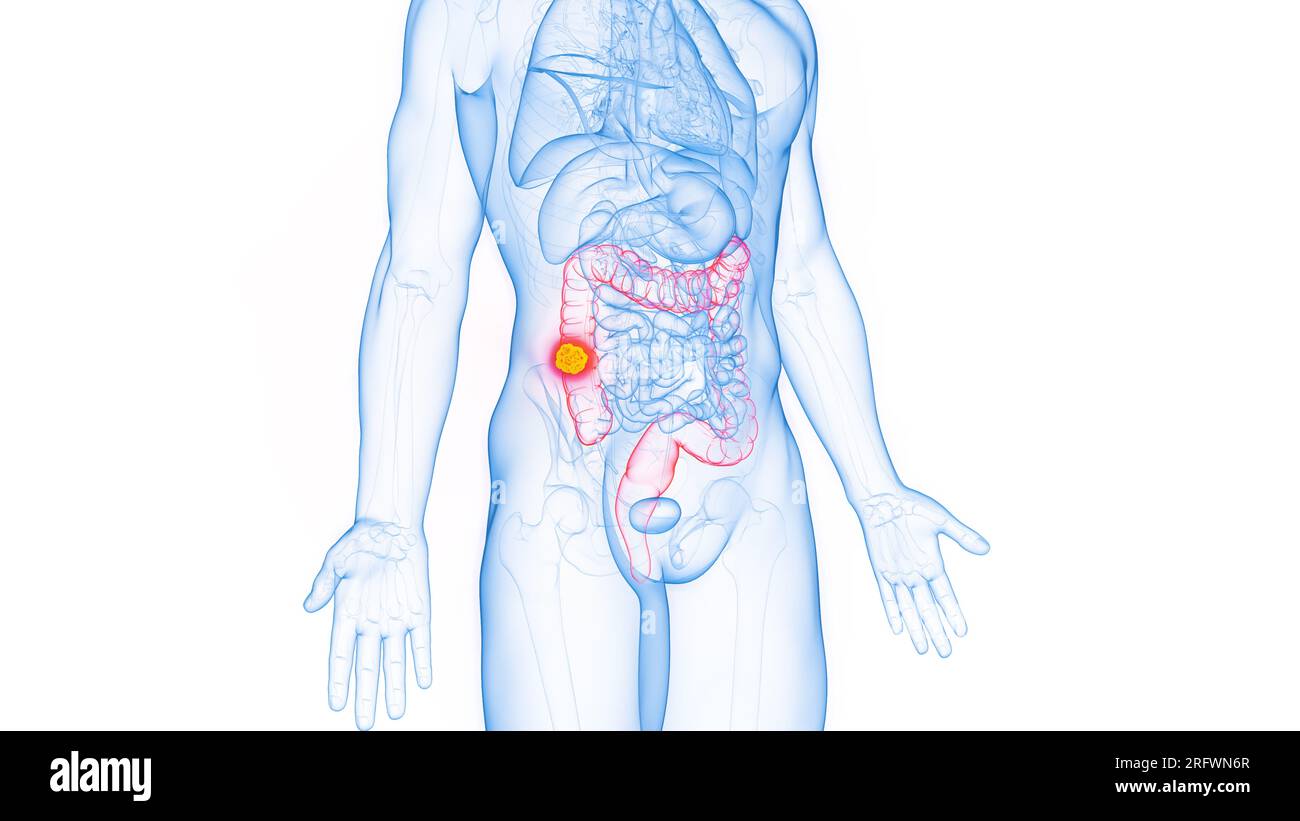 Colon cancer, illustration Stock Photo