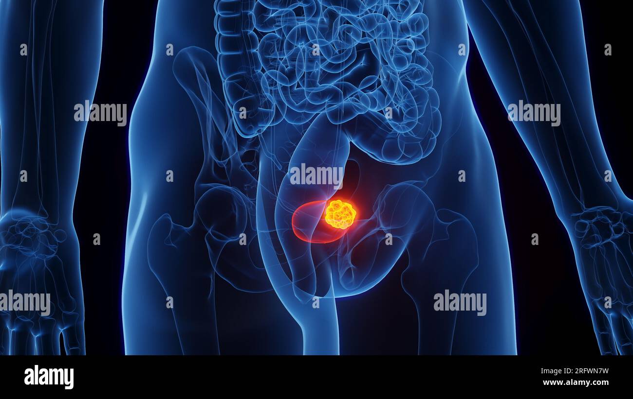 Urinary bladder cancer, illustration Stock Photo - Alamy