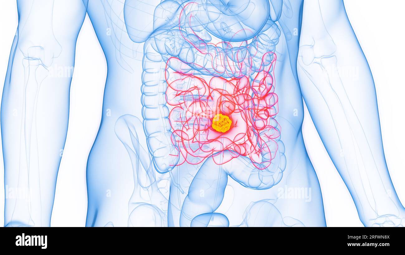 Cancer of the small intestine, illustration Stock Photo