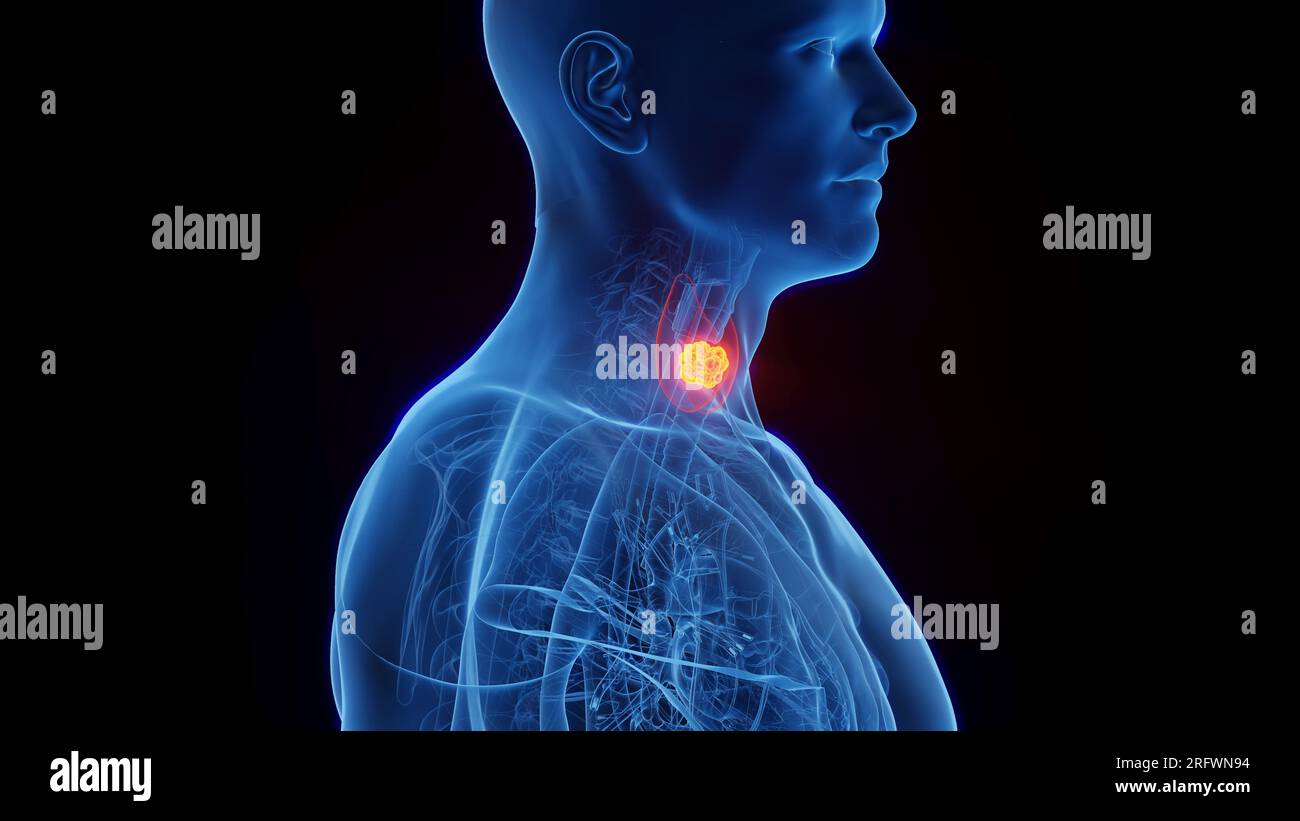 Thyroid cancer, illustration Stock Photo