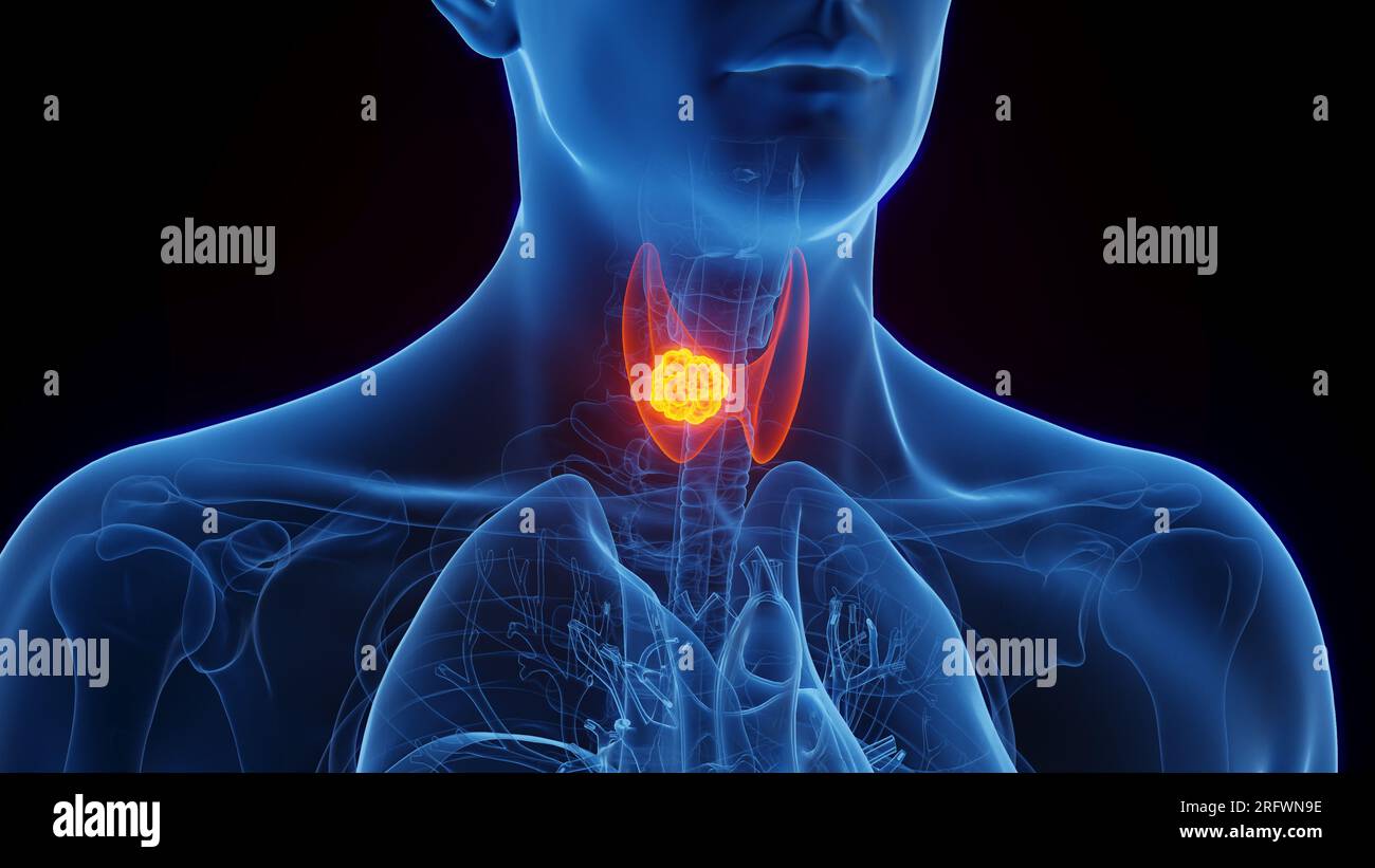 Thyroid cancer, illustration Stock Photo