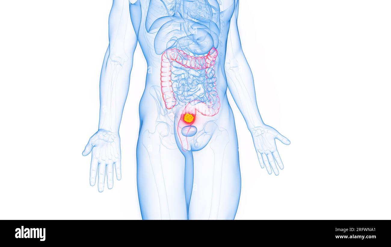Reca Cancer Map Rectal cancer, illustration Stock Photo - Alamy