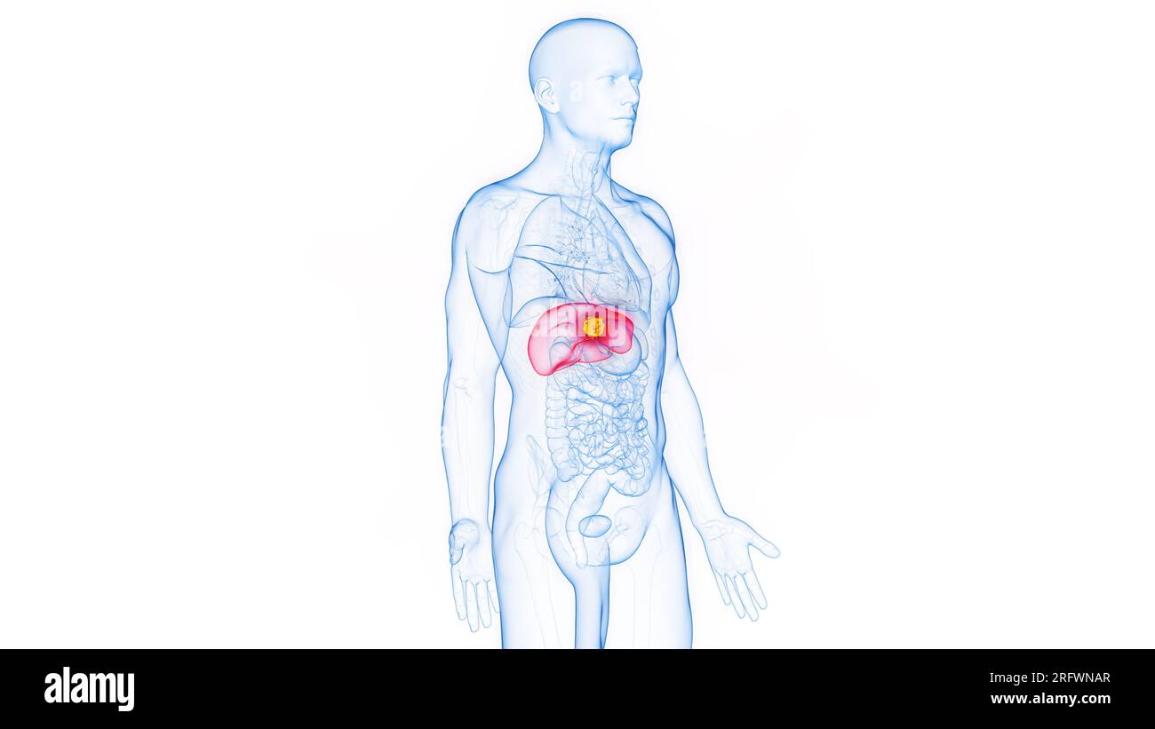 Hepatic mass hi-res stock photography and images - Alamy, image size:1300x821