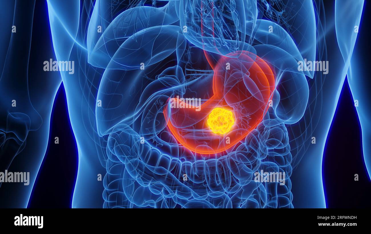 Stomach cancer, illustration Stock Photo - Alamy