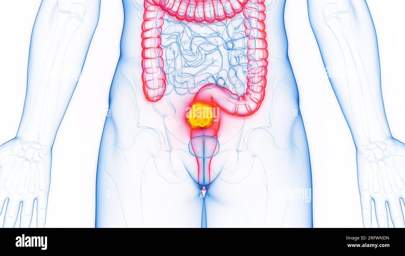 Reca Cancer Map Cancerous rectal polyp hi-res stock photography and images - Alamy