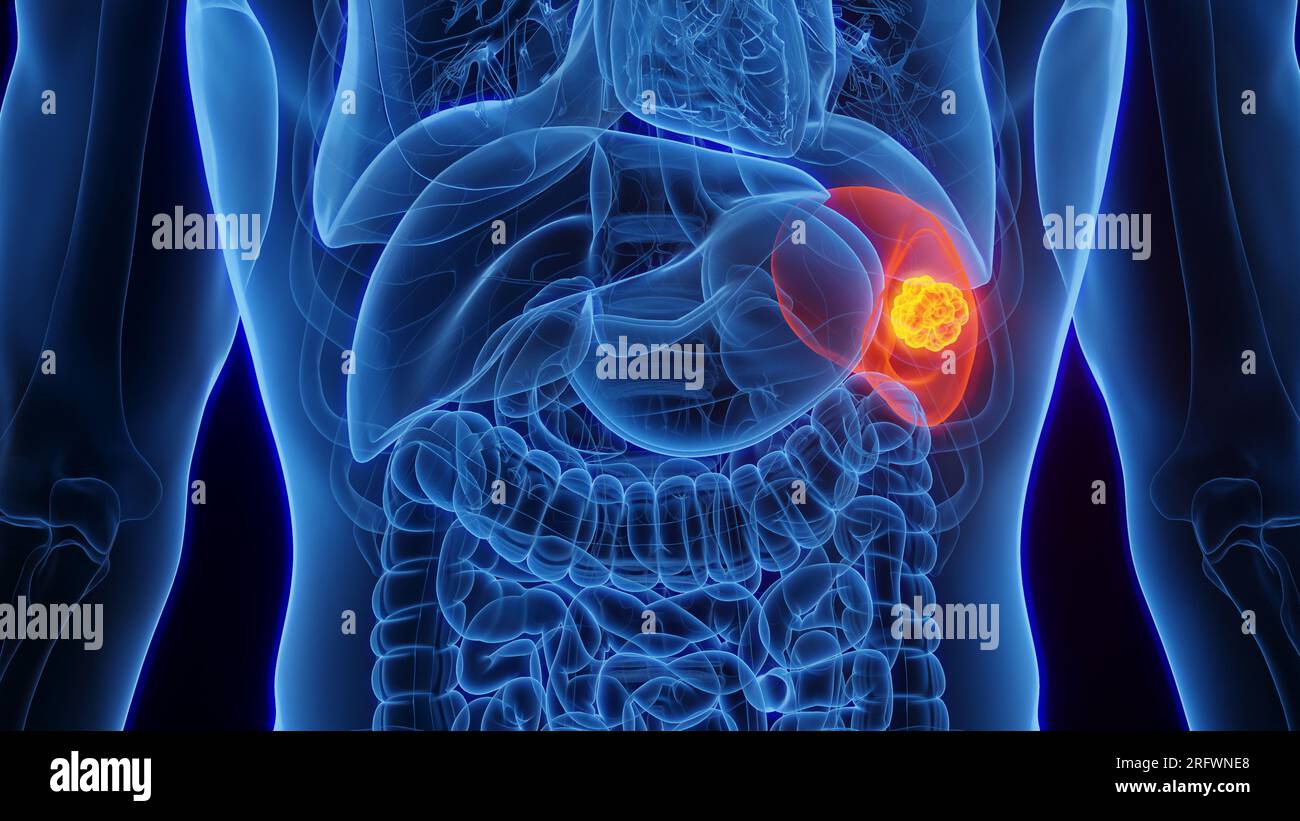 Splenic cancer, illustration Stock Photo - Alamy