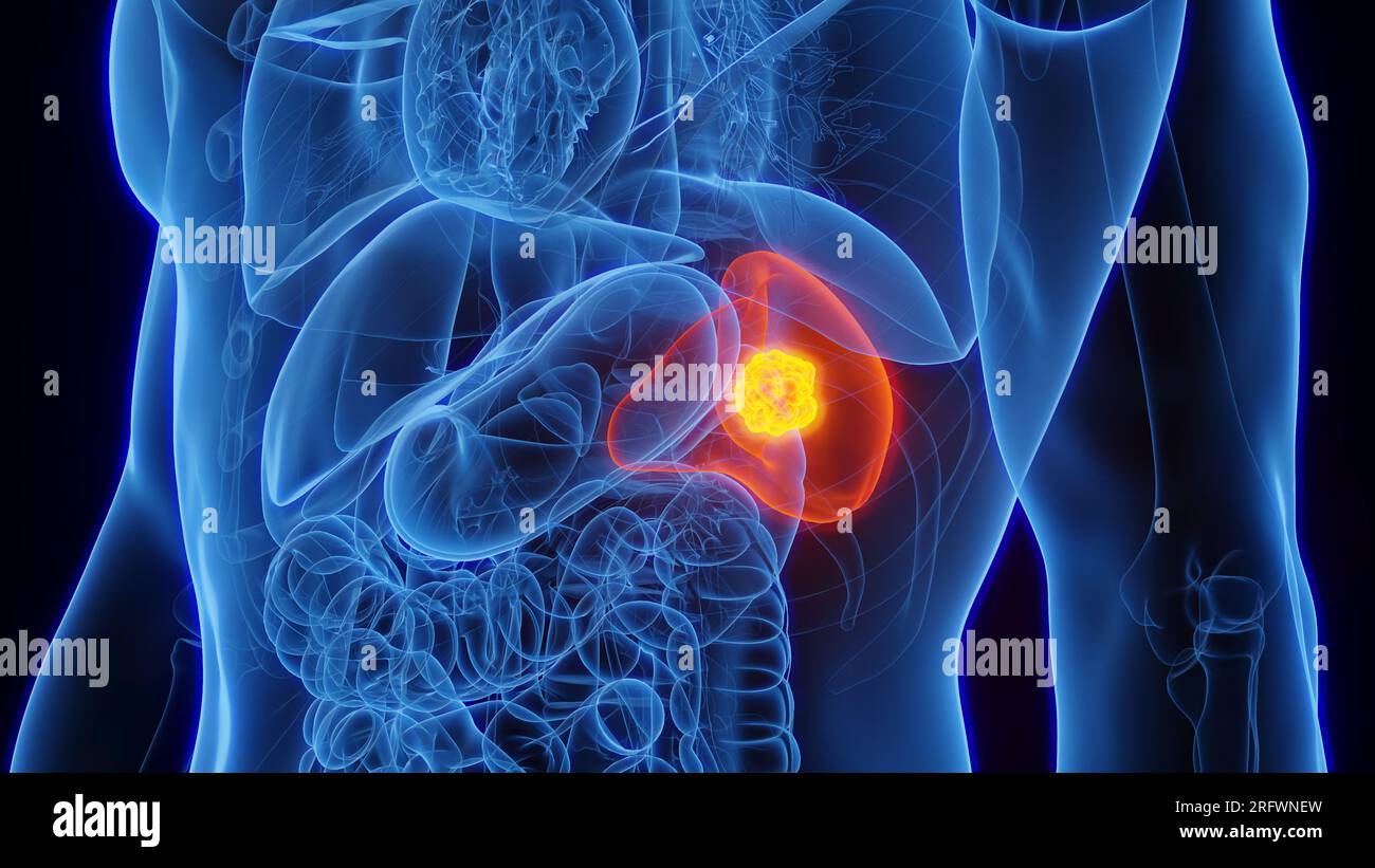 Splenic cancer, illustration Stock Photo - Alamy