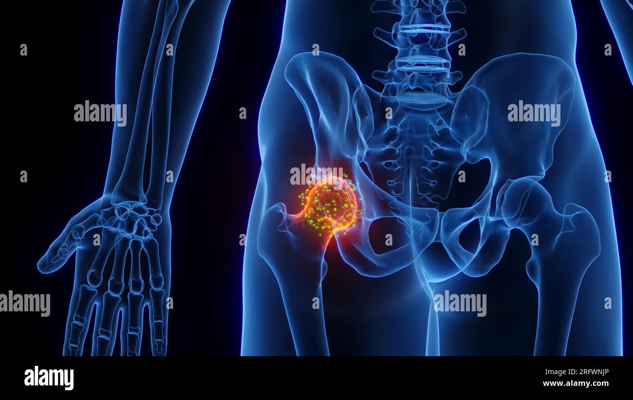 Inflamed hip joint healing, illustration Stock Photo Alamy