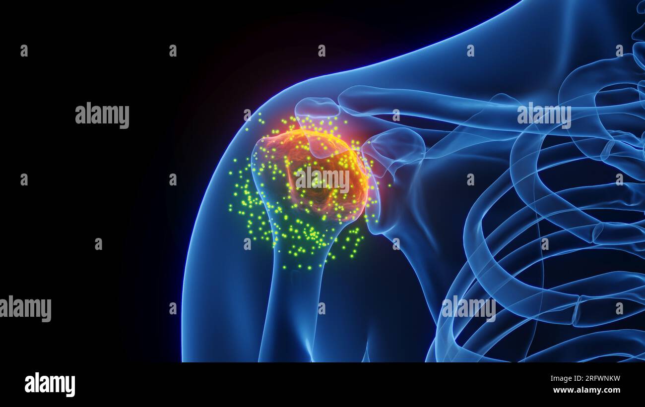 Inflamed shoulder joint healing, illustration Stock Photo Alamy