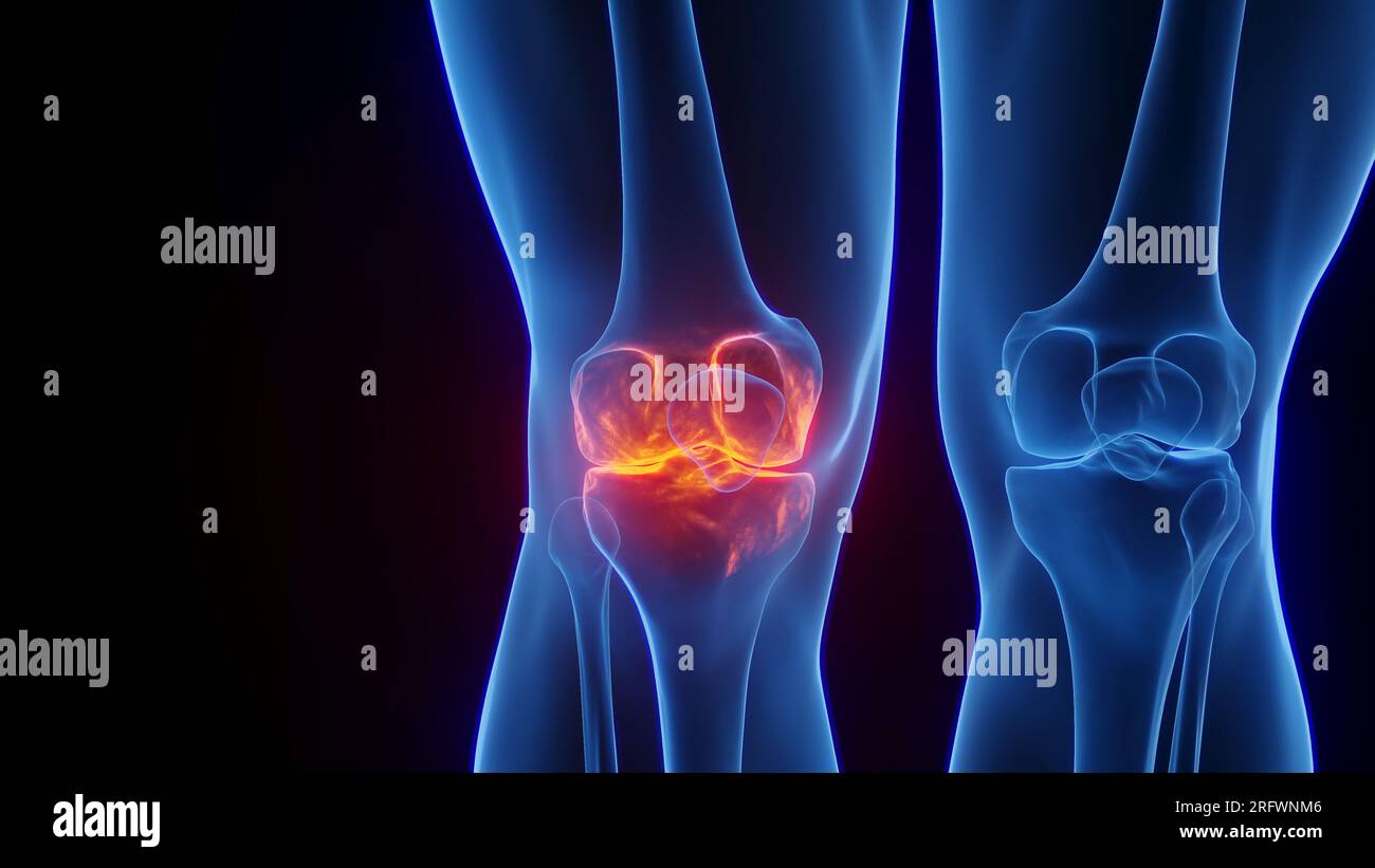 Inflamed knee, illustration Stock Photo - Alamy