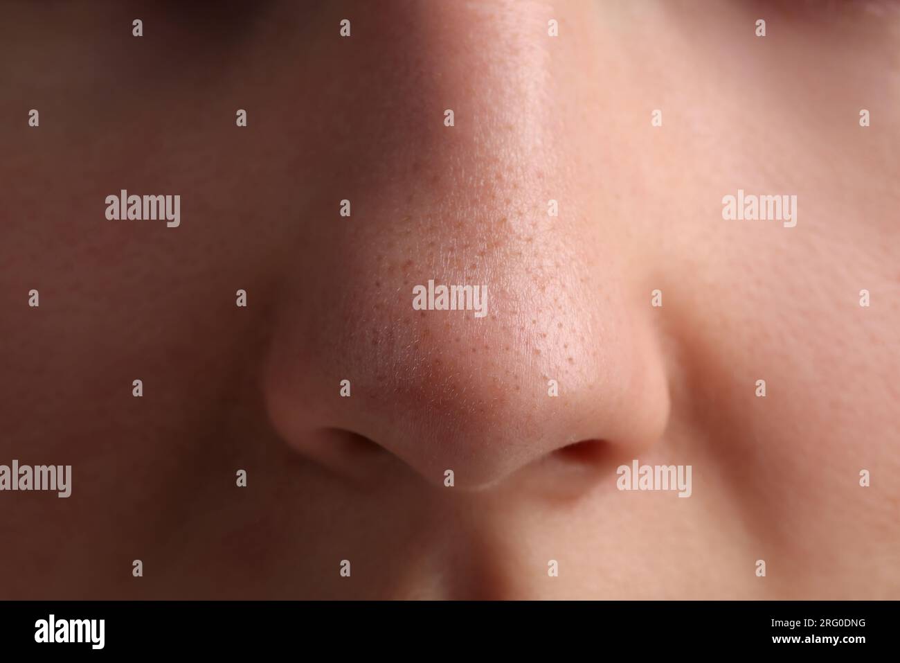 Young woman with acne problem, closeup view of nose Stock Photo