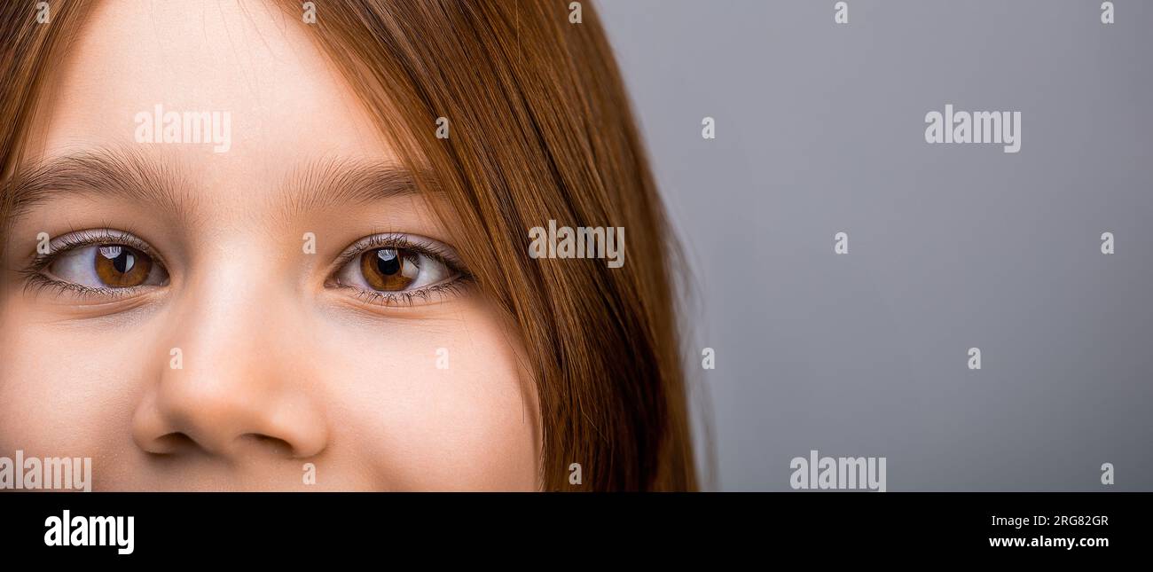 Strabismus in children causes, treatment concept. Female eyes with strabismus. Hypertropia. Strabismus. Closeup part child's face, eyes girl. Little Stock Photo