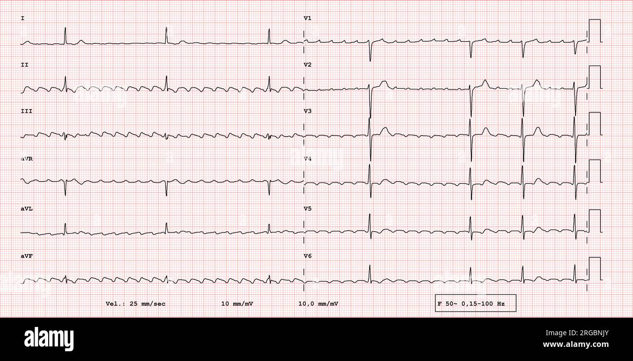 ECG example of 12-lead rhythm,  Atrial flutter with slow ventricular rate, real exam Stock Photo
