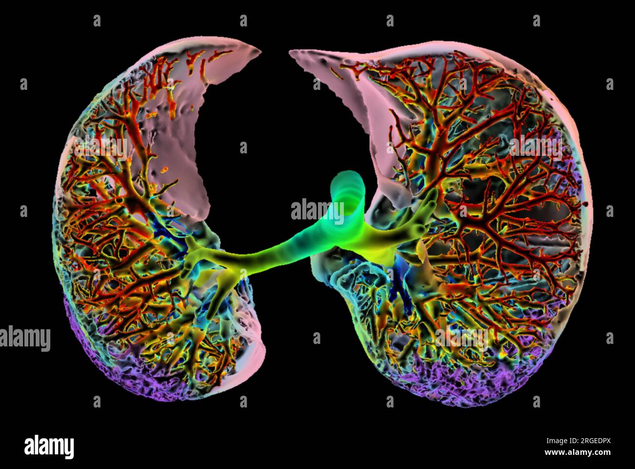 Interstitial lung disease, 3D CT scan Stock Photo - Alamy