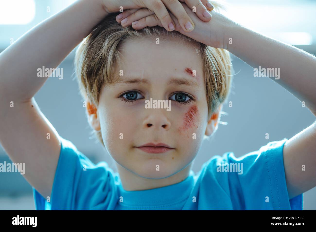 Portrait of a child with scratches after fall on his face Stock Photo