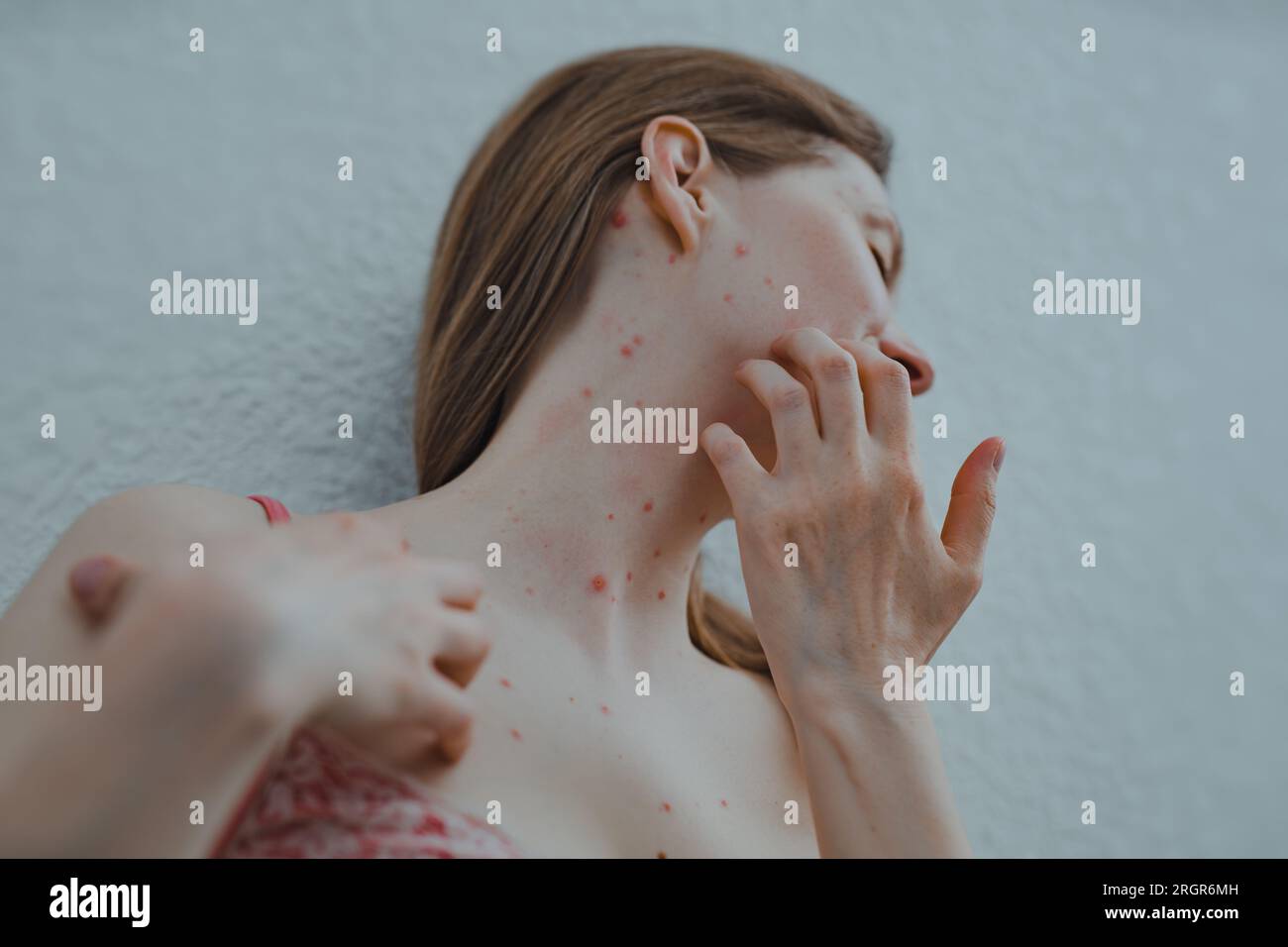 A woman with chicken pox scratches her skin Stock Photo