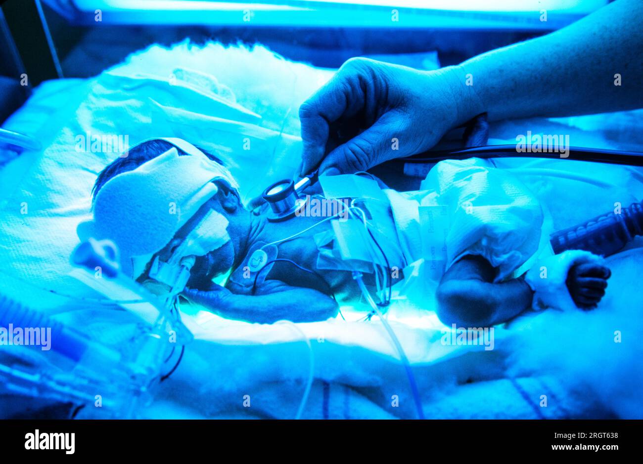 A neonatal intensive care hospital doctor monitors  a tiny premature infant under blue ultraviolet light. Stock Photo