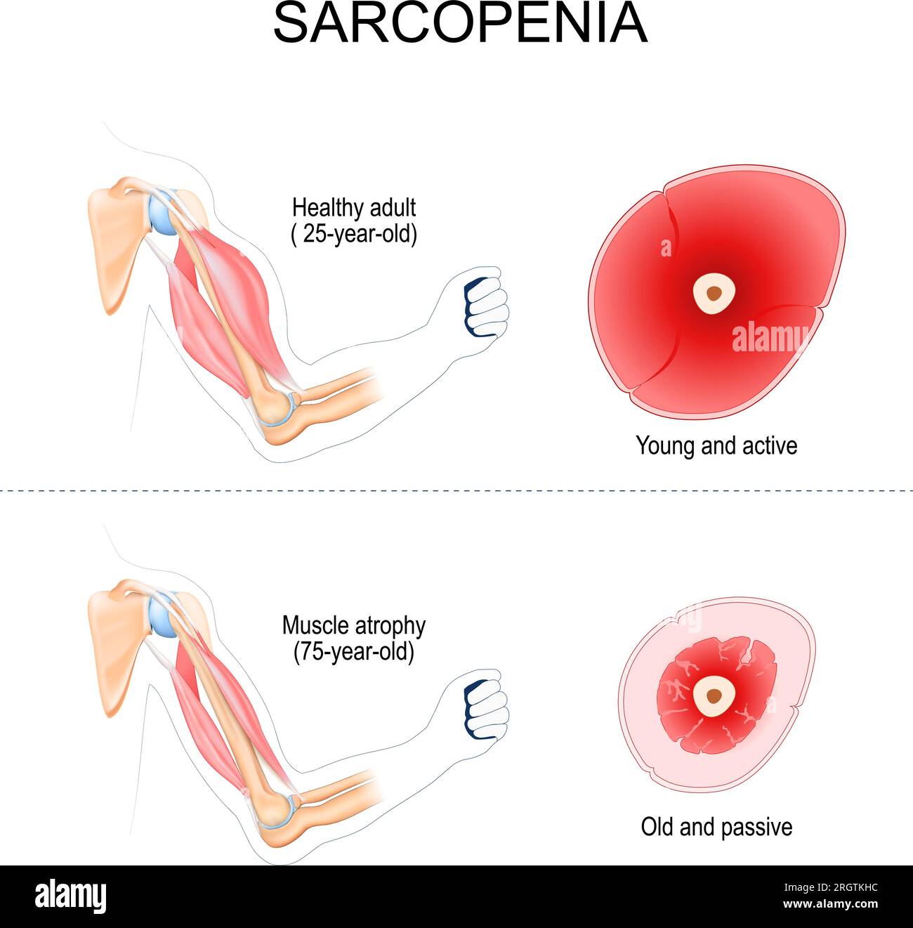 sarcopenia. Comparison and Difference between muscles of Healthy adult