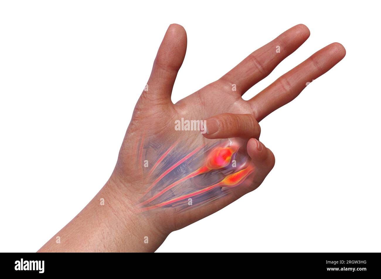 Dupuytren's contracture, illustration Stock Photo