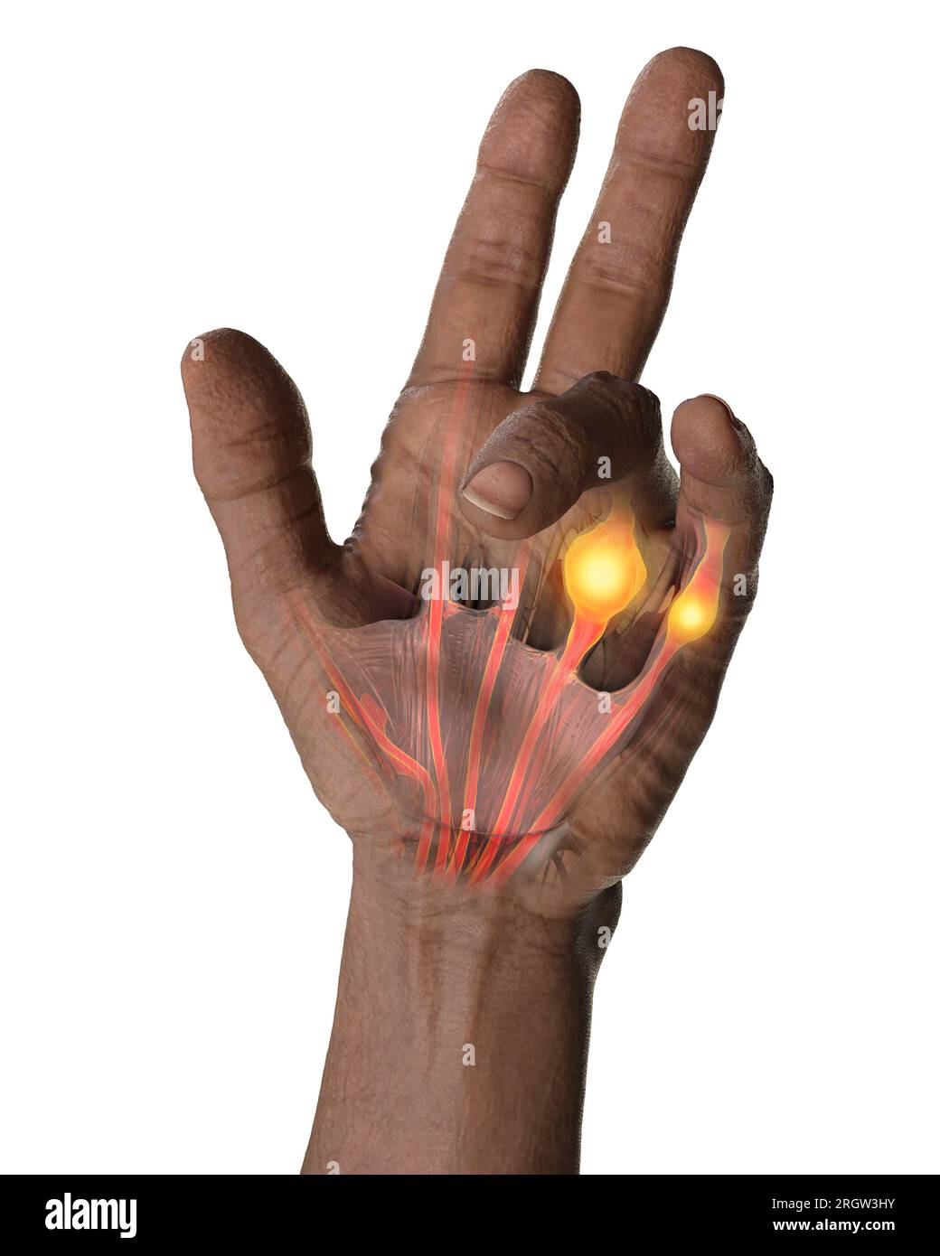 A computer illustration displaying a patient's hand with Dupuytren's