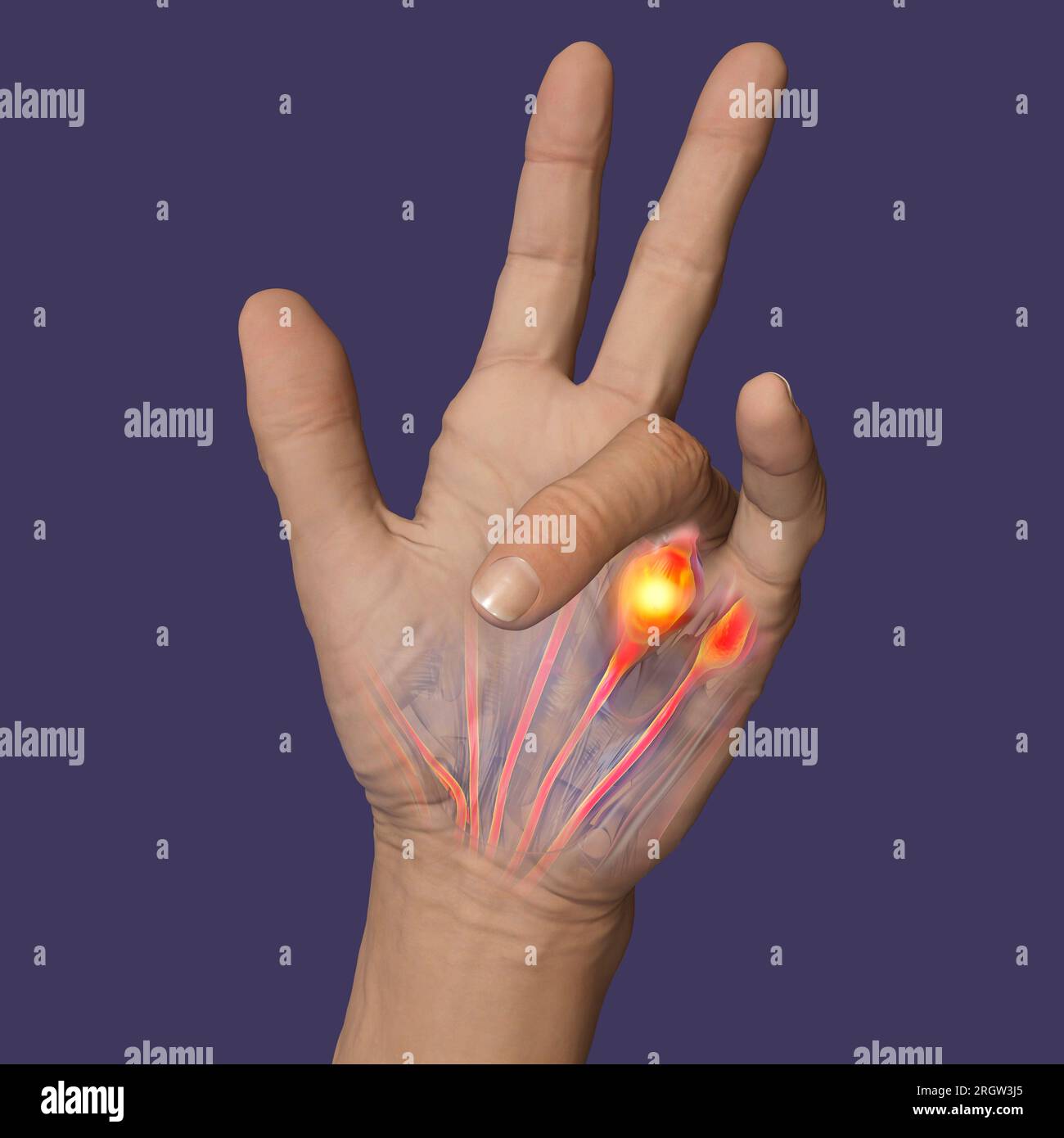 Illustration displaying a patient's hand with Dupuytren's contracture