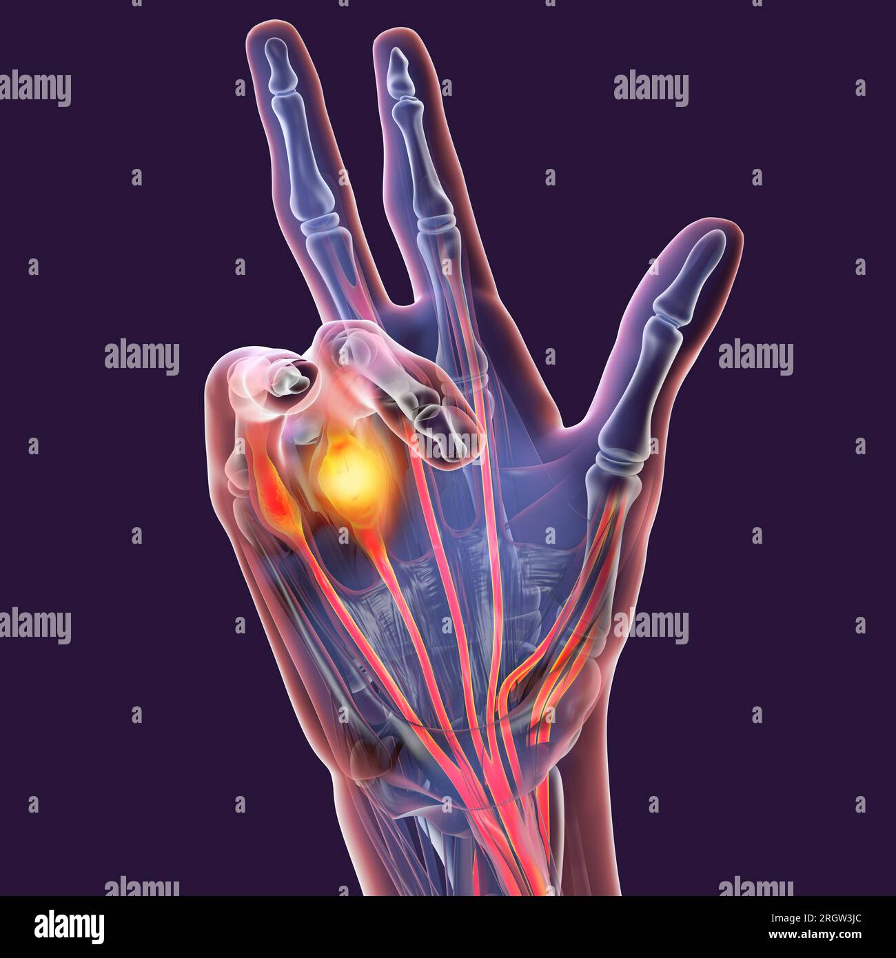 Illustration Displaying A Patient's Hand With Dupuytren's Contracture ...