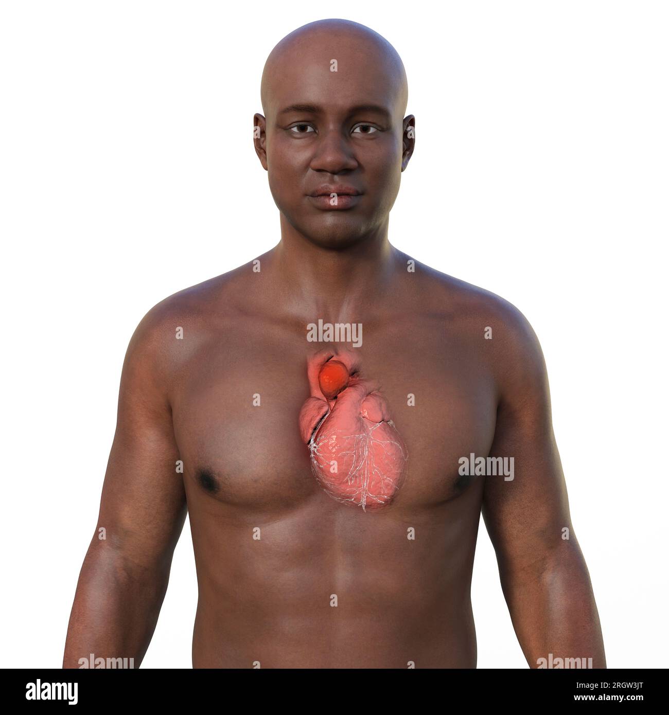 Ascending aortic aneurysm, illustration Stock Photo Alamy