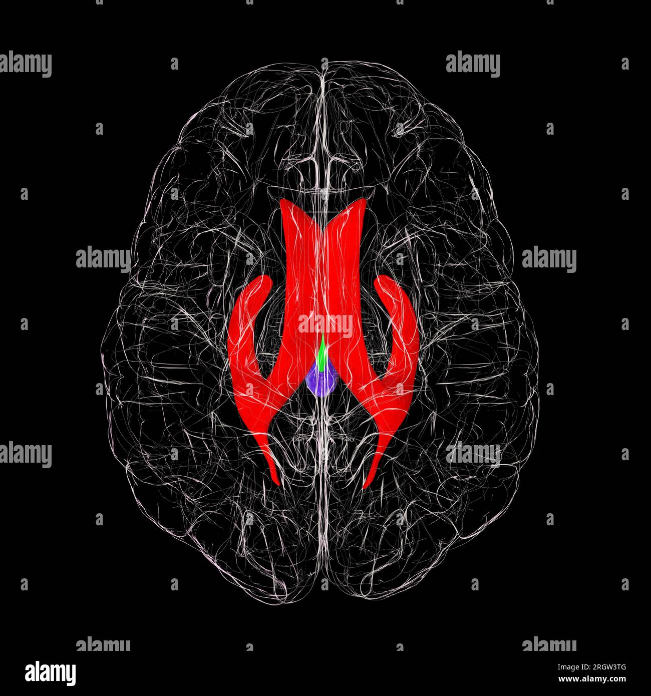 Ventricular System