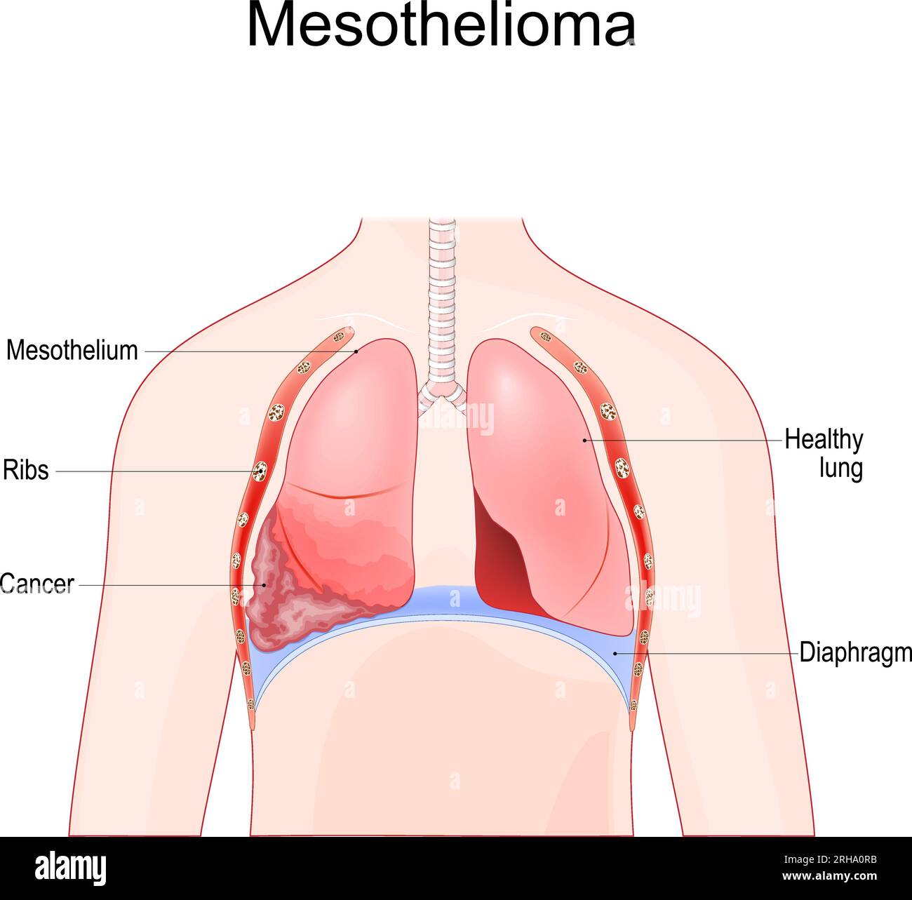 mesothelioma. Malignant tumor of lung after Asbestos exposure. Vector illustration Stock Vector