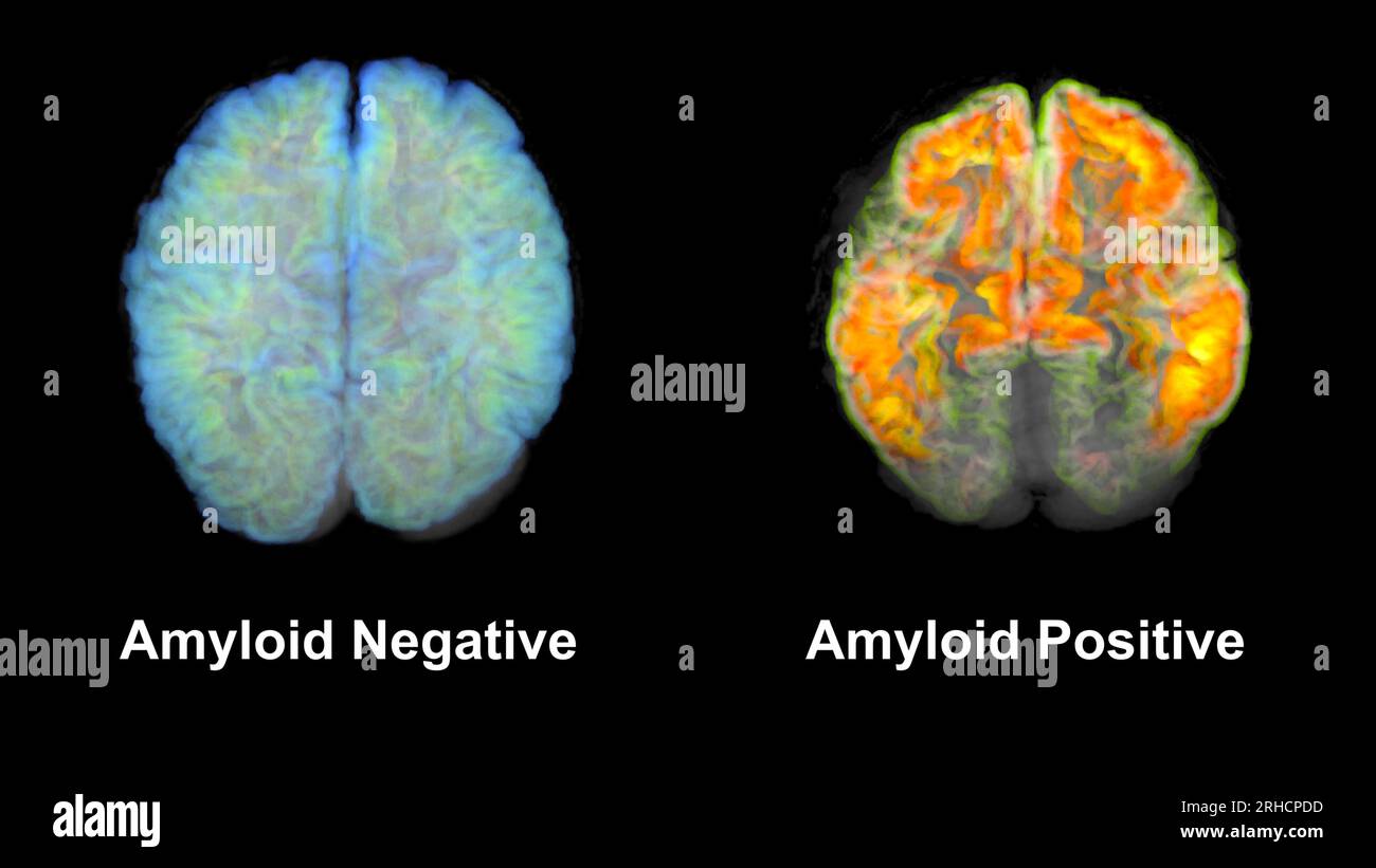 Healthy brain and brain with amyloid plaques, MRI scans Stock Photo Alamy