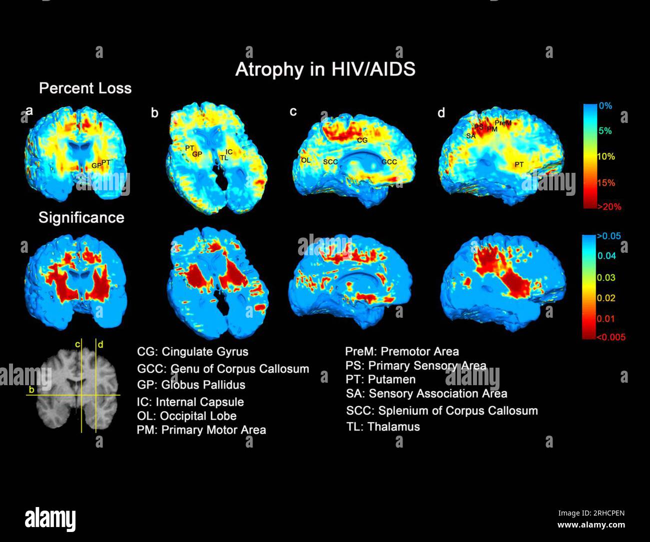 Brain atrophy in HIV/AIDS, MRI scans Stock Photo - Alamy