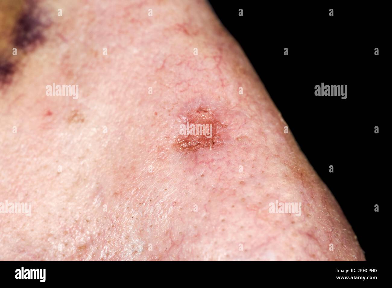 Basal cell carcinoma Stock Photo - Alamy