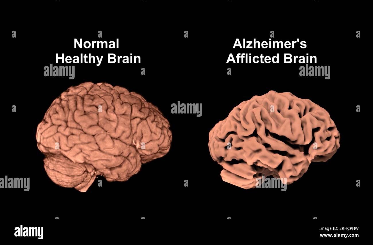 Healthy brain and Alzheimer's brain, MRI scans Stock Photo - Alamy