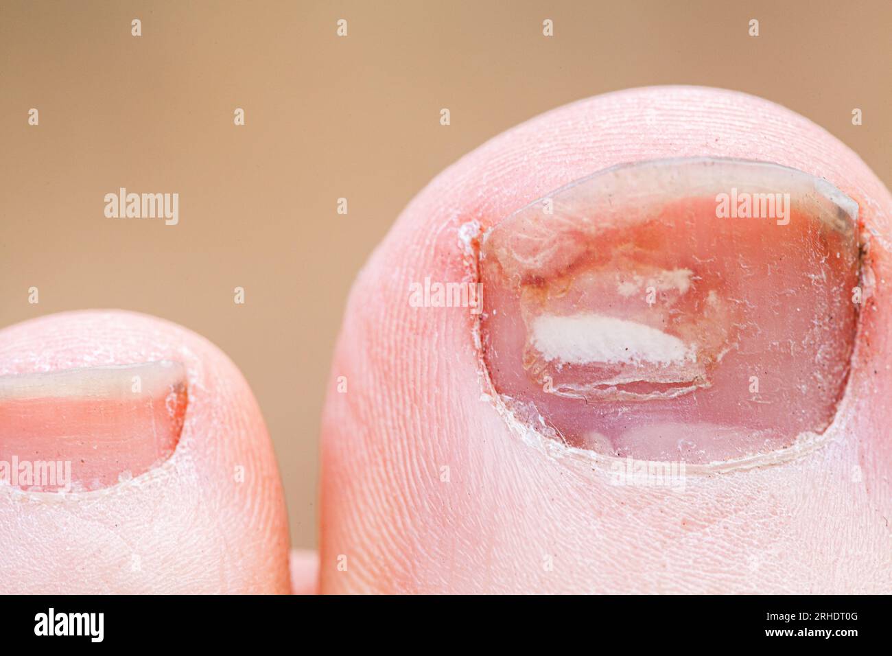 Macro shot of toe with nail growing back in after injury that damaged toenail Stock Photo
