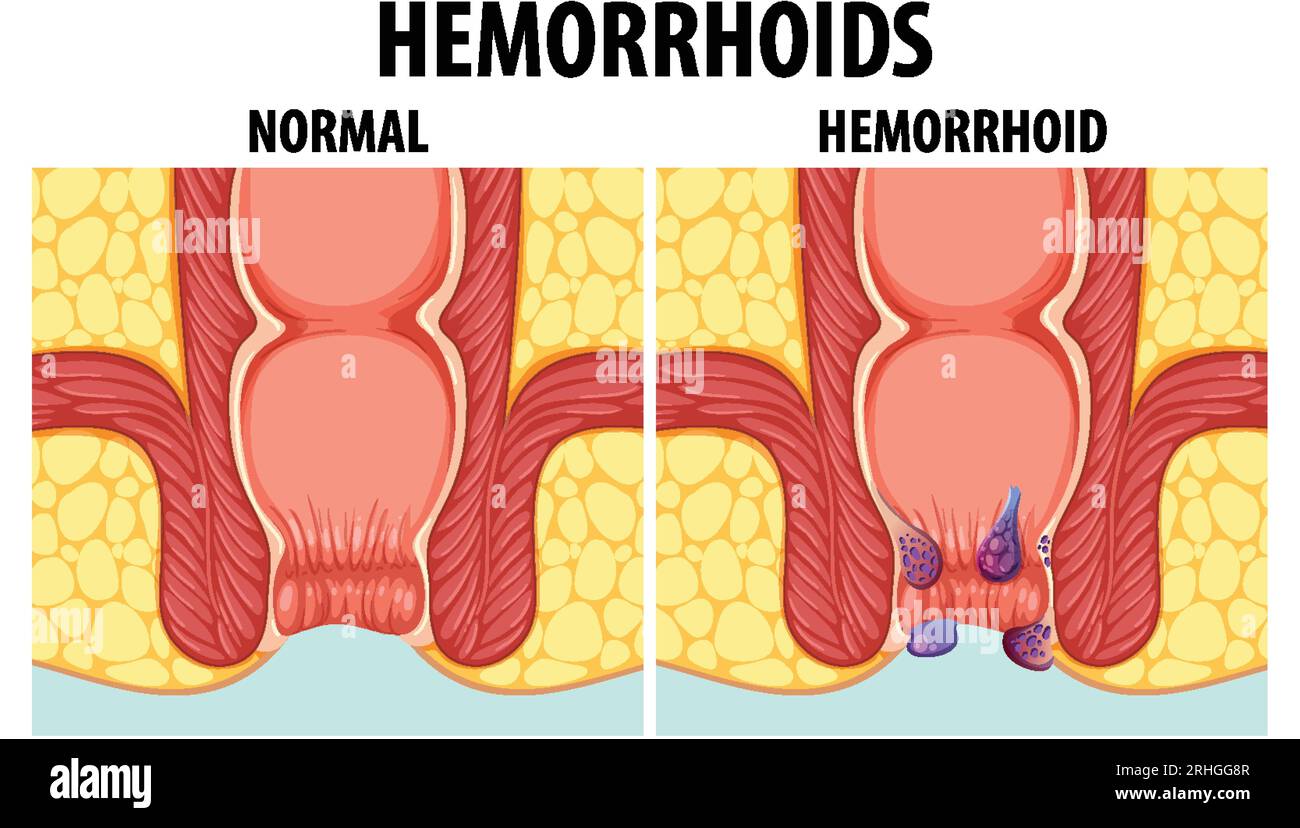 Educational graphic illustrating the differences between normal and internal hemorrhoids Stock Vector