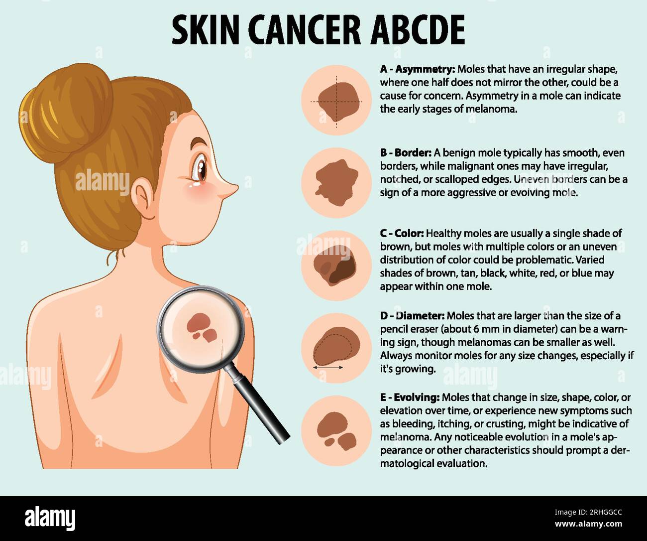 Irregular Skin Illustrated infographic depicting abnormal growth of skin cells in skin ...
