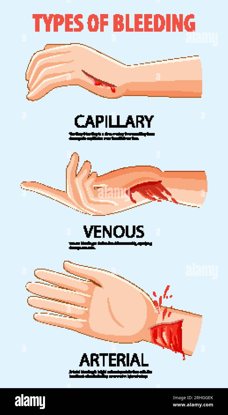 Peter Bowles On X 3 Main Types Of Bleeding Capillary Slow, 59 OFF