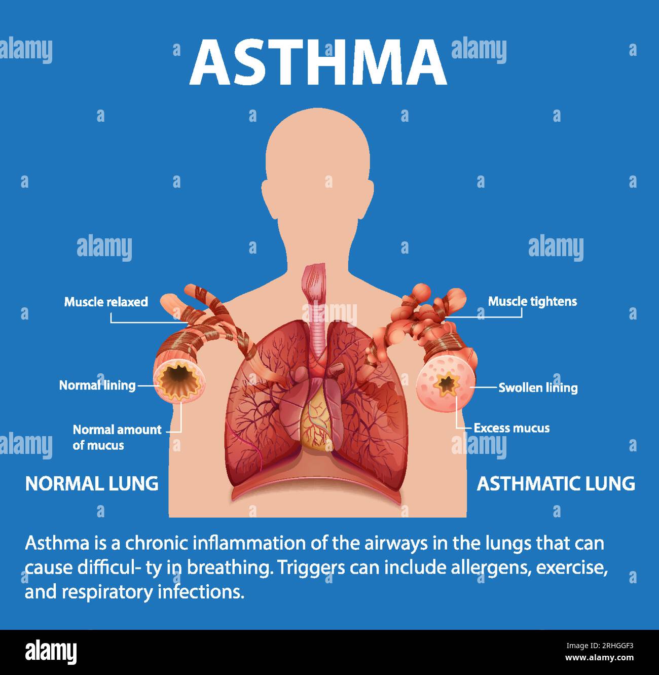 Illustrated infographic comparing human lungs in normal and asthma conditions Stock Vector Image