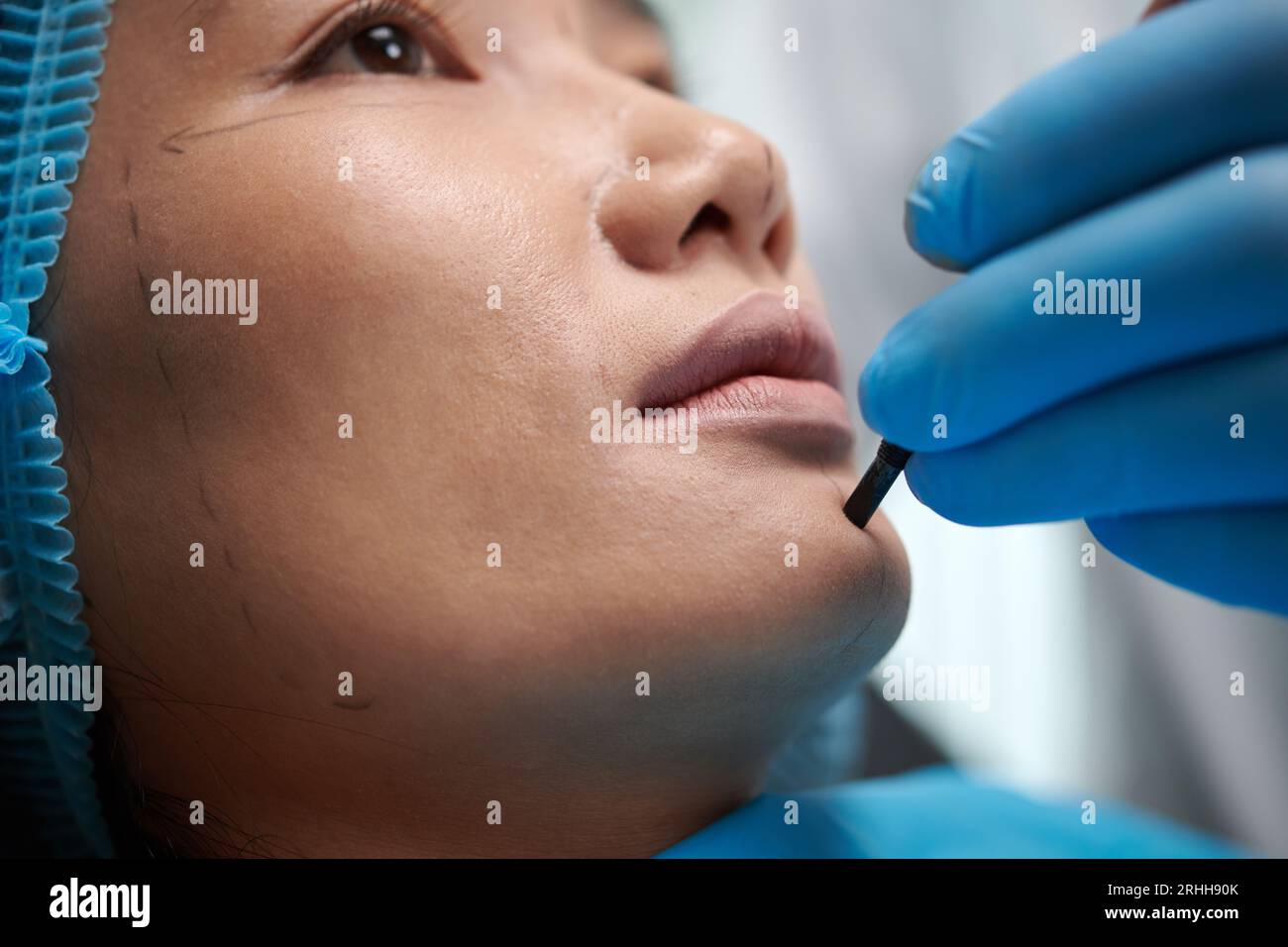 Closeup image of plastic surgeon marking face of patient before chin filler injection Stock Photo